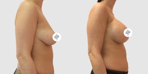 This is one of our beautiful breast augmentation patient 40
