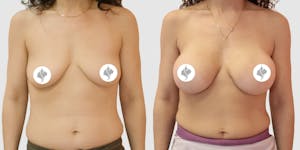 This is one of our beautiful breast augmentation patient 41