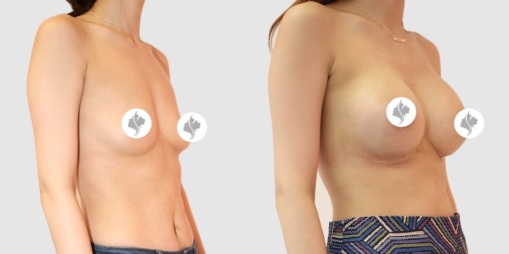 This is one of our beautiful breast augmentation patient #4