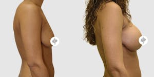 This is one of our beautiful breast augmentation patient 42