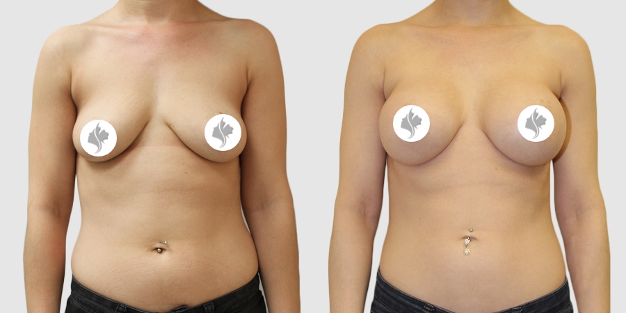 This is one of our beautiful breast augmentation patient 43