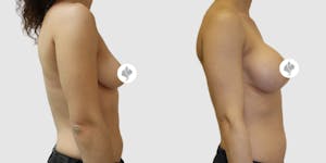 This is one of our beautiful breast augmentation patient 43