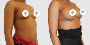 This is one of our beautiful breast augmentation patient 44