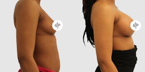 This is one of our beautiful breast augmentation patient 44