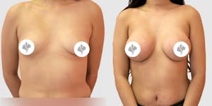 This is one of our beautiful breast augmentation patient 45
