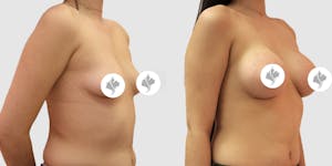 This is one of our beautiful breast augmentation patient 45