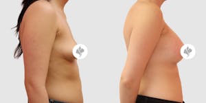 This is one of our beautiful breast augmentation patient 46