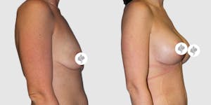 This is one of our beautiful breast augmentation patient 47
