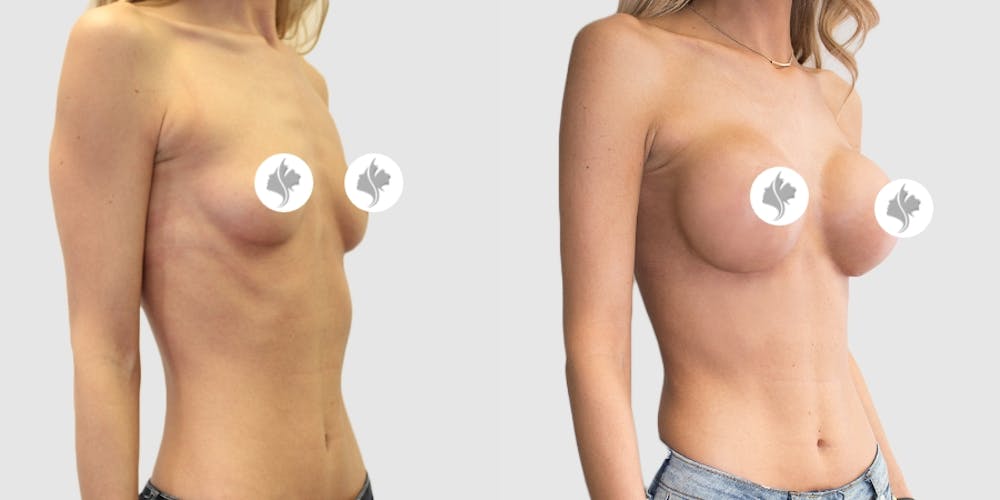 This is one of our beautiful breast augmentation patient #5