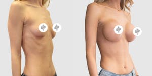This is one of our beautiful breast augmentation patient 5