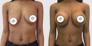 This is one of our beautiful breast augmentation patient 6