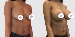This is one of our beautiful breast augmentation patient 6