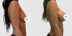 This is one of our beautiful breast augmentation patient 6