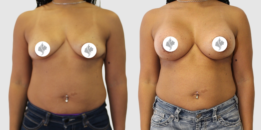 This is one of our beautiful breast augmentation patient 49