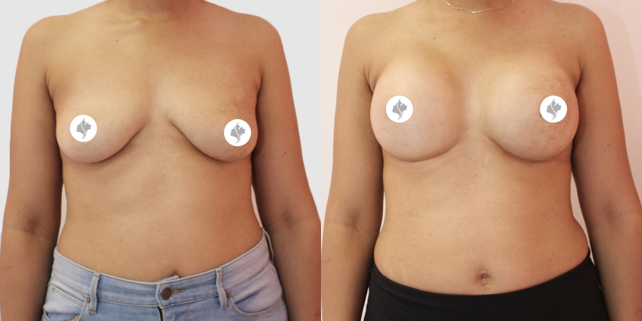 This is one of our beautiful breast augmentation patient 50