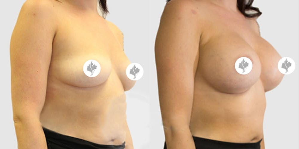 This is one of our beautiful breast augmentation patient #13