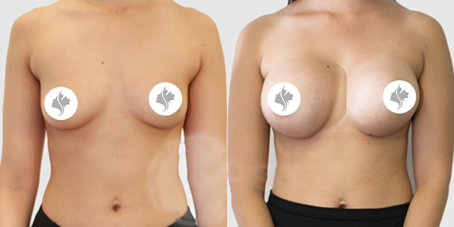 This is one of our beautiful breast augmentation patient 53