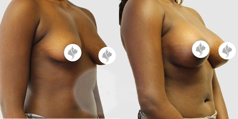 This is one of our beautiful breast augmentation patient #55