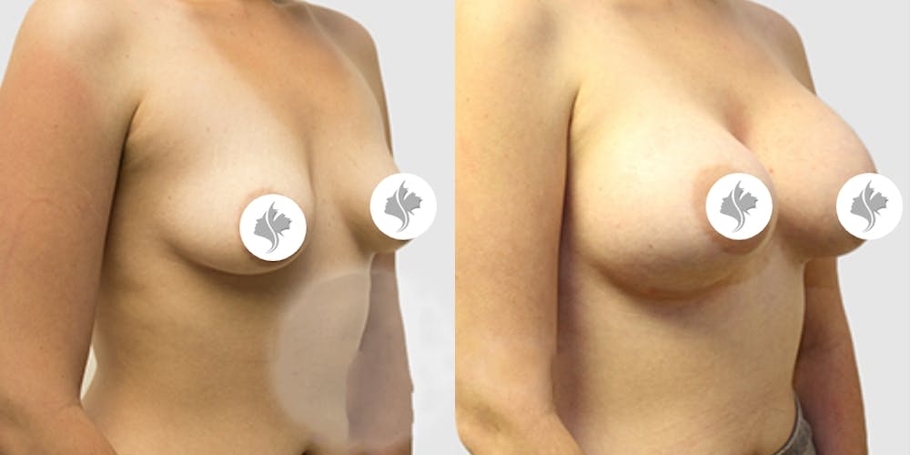 This is one of our beautiful breast augmentation patient #14