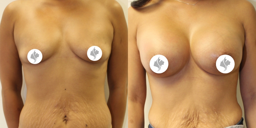 This is one of our beautiful breast augmentation patient 56