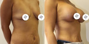 This is one of our beautiful breast augmentation patient 56