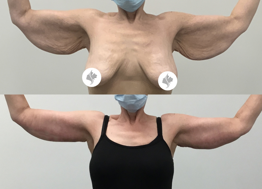 This is one of our beautiful arm lift patient 8