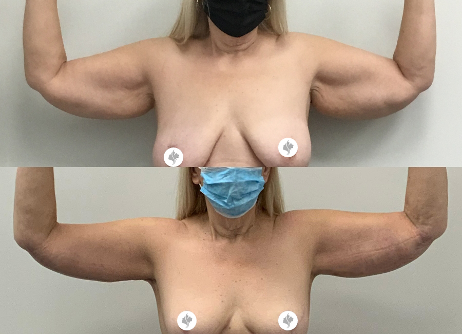 This is one of our beautiful arm lift patient 3