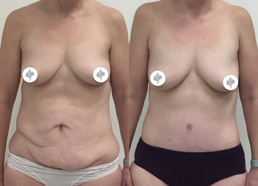 This is one of our beautiful tummy tuck patient 36