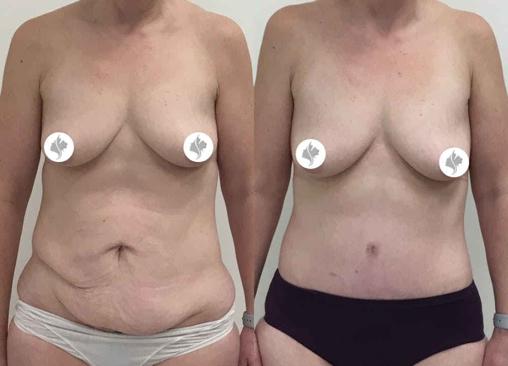 This is one of our beautiful tummy tuck patient #36