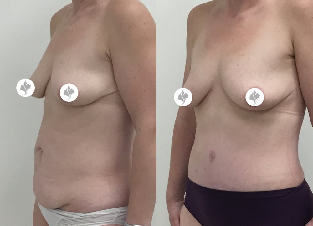 This is one of our beautiful tummy tuck patient #36