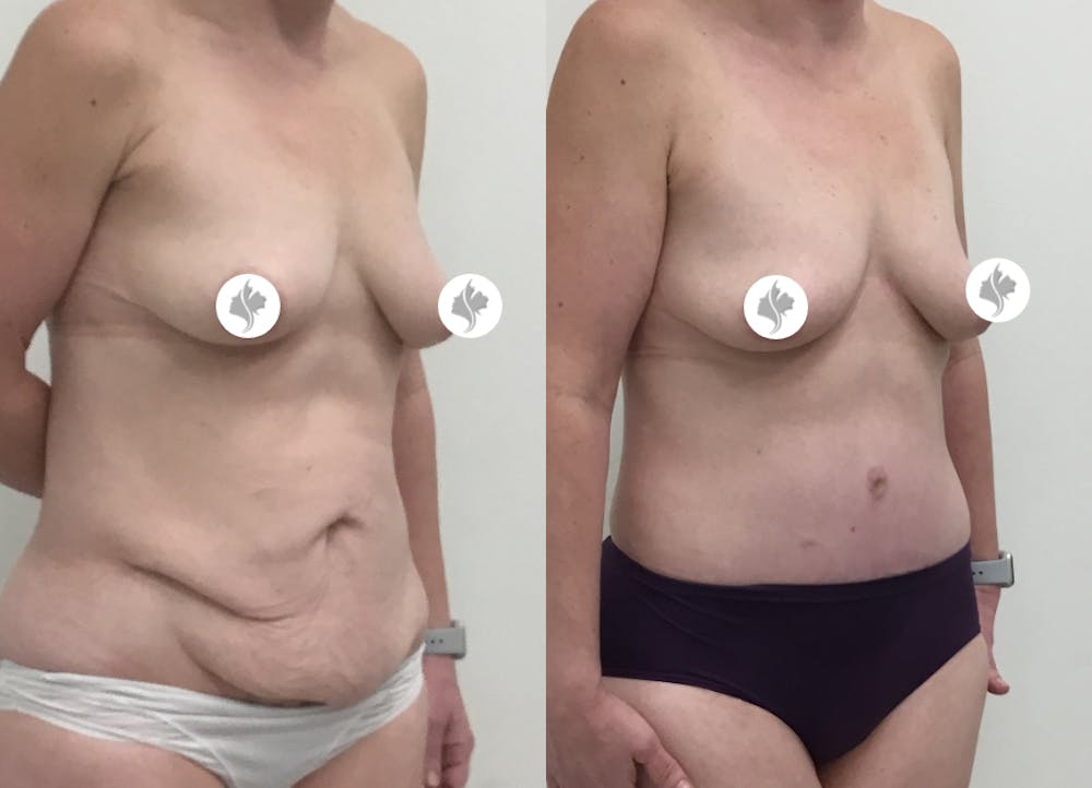 This is one of our beautiful tummy tuck patient #36