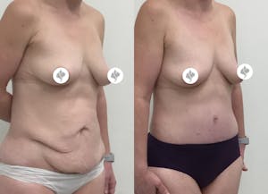 This is one of our beautiful tummy tuck patient 31