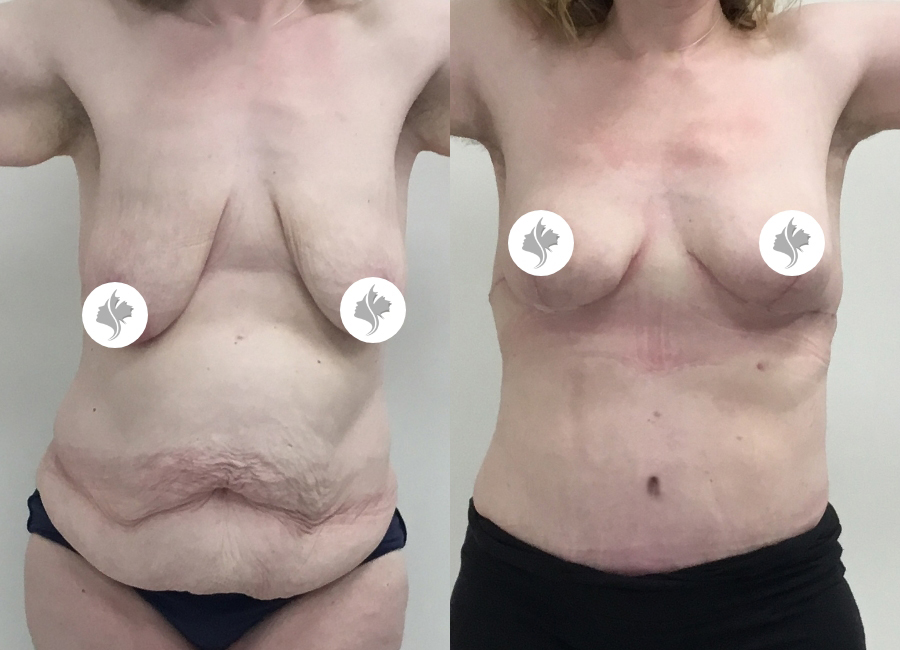 This is one of our beautiful tummy tuck patient 67