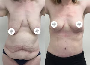 This is one of our beautiful tummy tuck patient 63