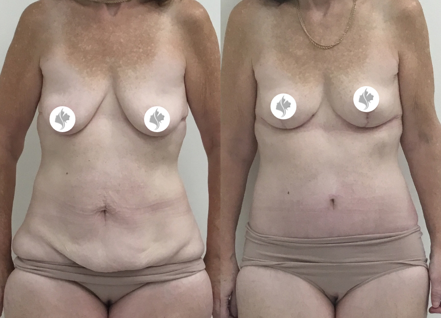 This is one of our beautiful tummy tuck patient 69