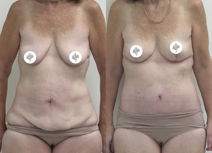 This is one of our beautiful tummy tuck patient 73