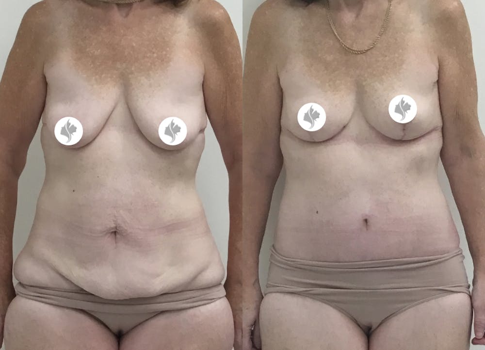 This is one of our beautiful tummy tuck patient #73