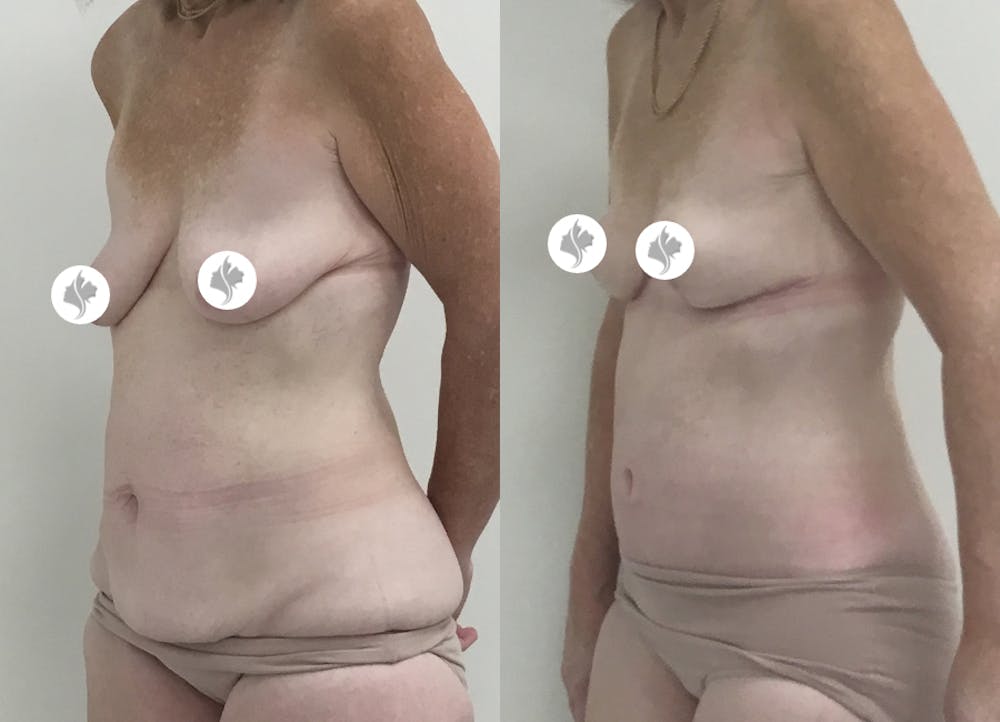This is one of our beautiful tummy tuck patient #73