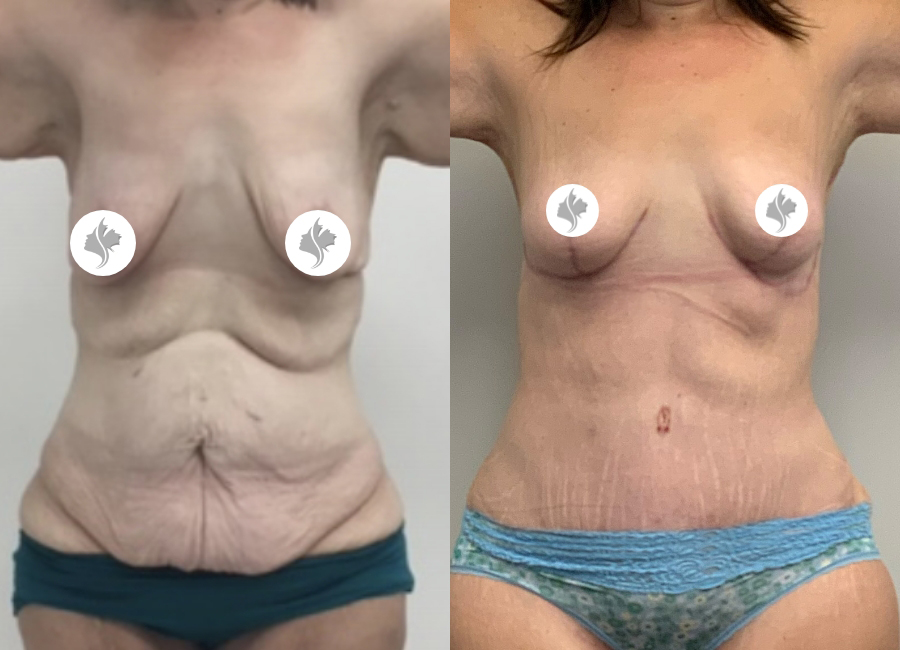 This is one of our beautiful tummy tuck patient 77