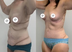 This is one of our beautiful tummy tuck patient 73