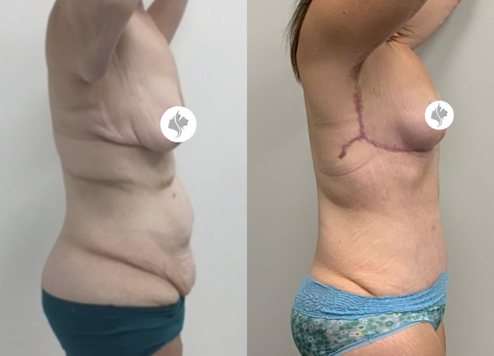 This is one of our beautiful tummy tuck patient #77