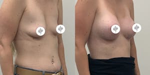 This is one of our beautiful breast augmentation patient 57