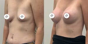 This is one of our beautiful breast augmentation patient 57