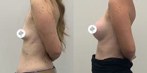 This is one of our beautiful breast augmentation patient 57
