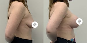 This is one of our beautiful breast reduction patient 88