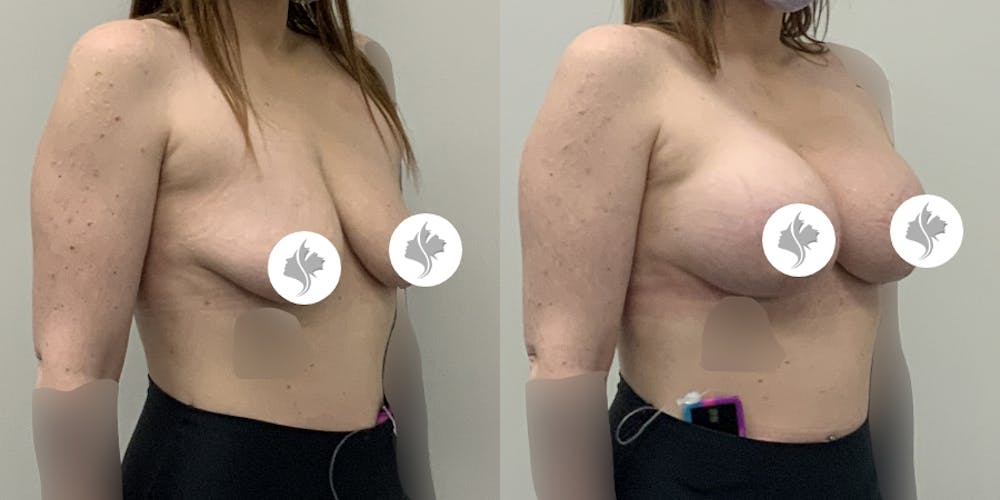 This is one of our beautiful breast augmentation patient #58