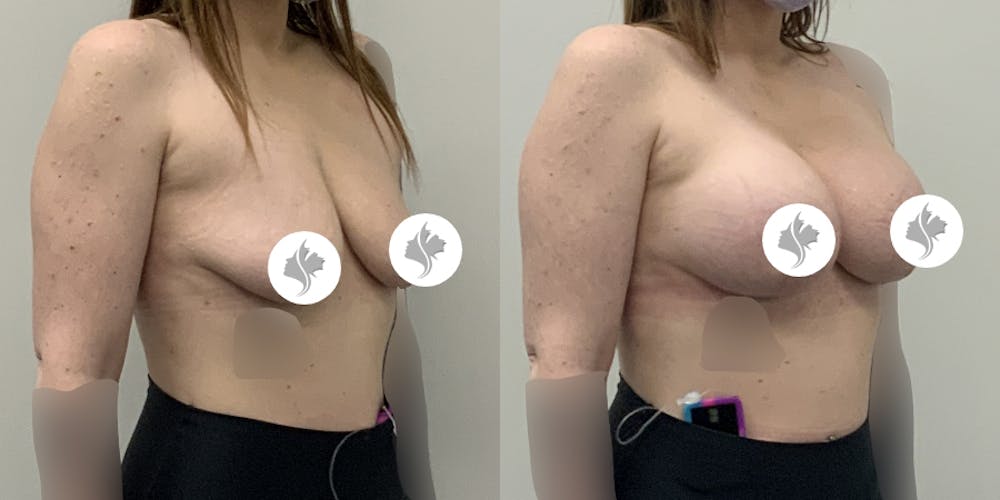 This is one of our beautiful breast augmentation with lift patient #3