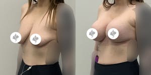 This is one of our beautiful breast augmentation with lift patient 3
