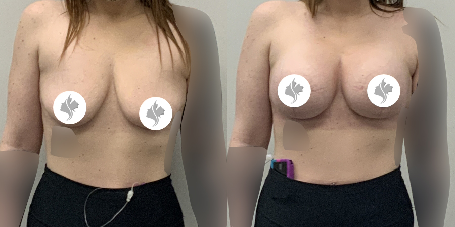 This is one of our beautiful breast augmentation patient 58