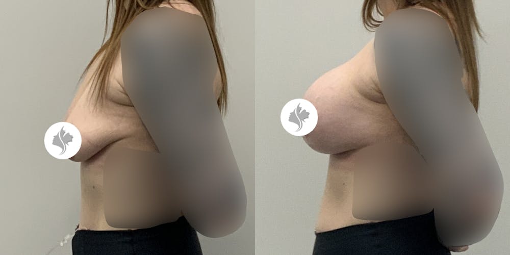 This is one of our beautiful breast augmentation patient #58